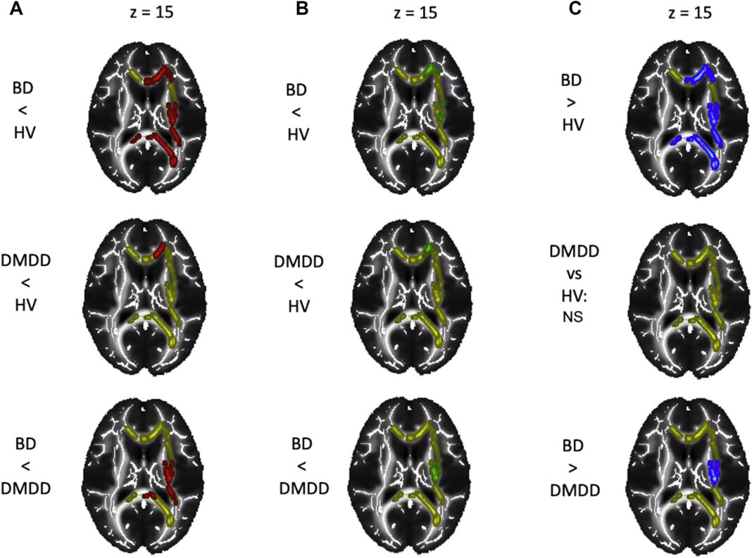 demystifying-dmdd-navigating-the-challenges-and-embracing-hope, this blog relevant health and very informatic about dmdd